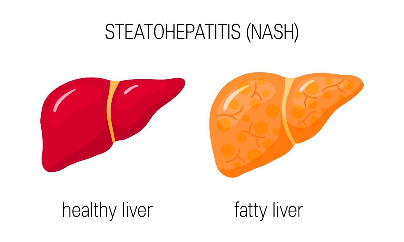 Keto Diet for Fatty Liver Disease: All You Need to Know About NAFLD Bariatric Station