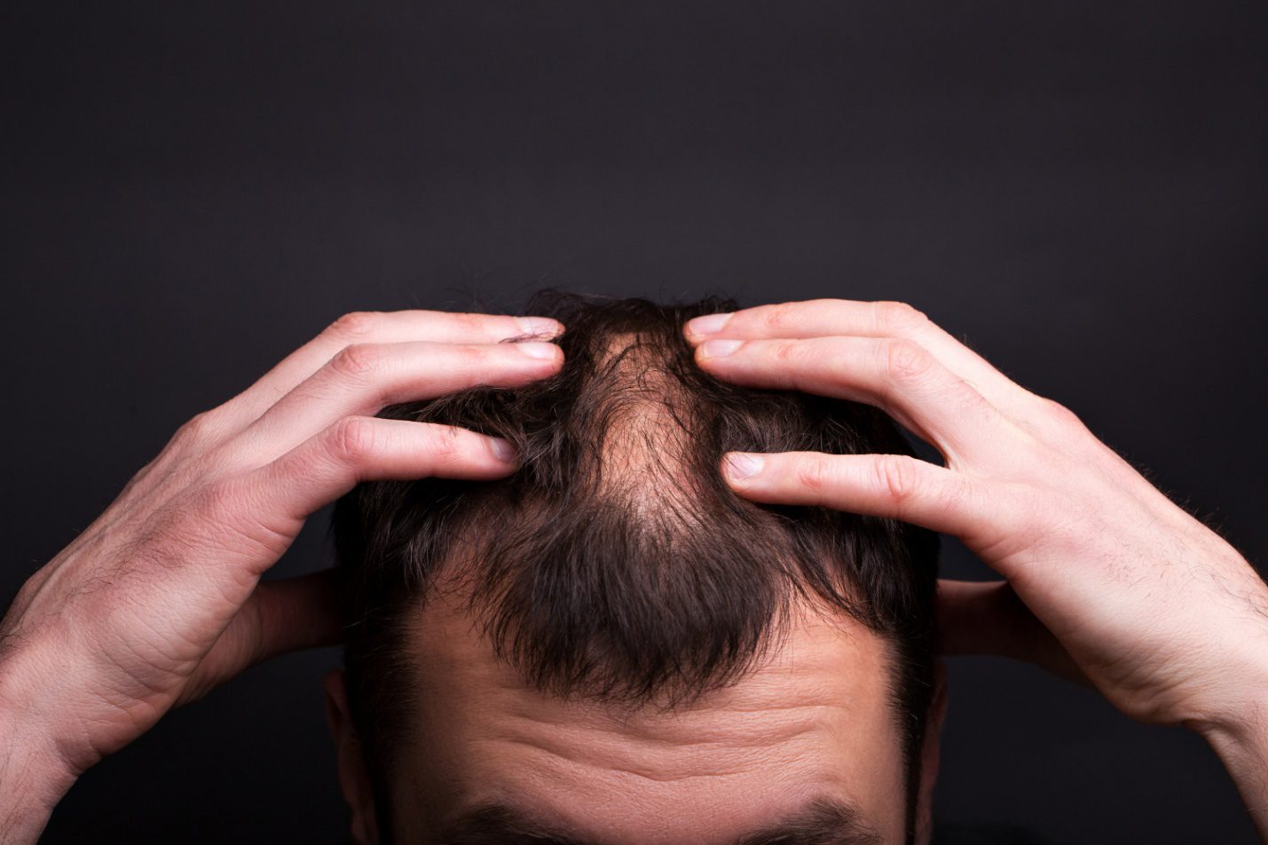 Keto Hair Loss: Myths and facts about Keto Hair Loss Bariatric Station