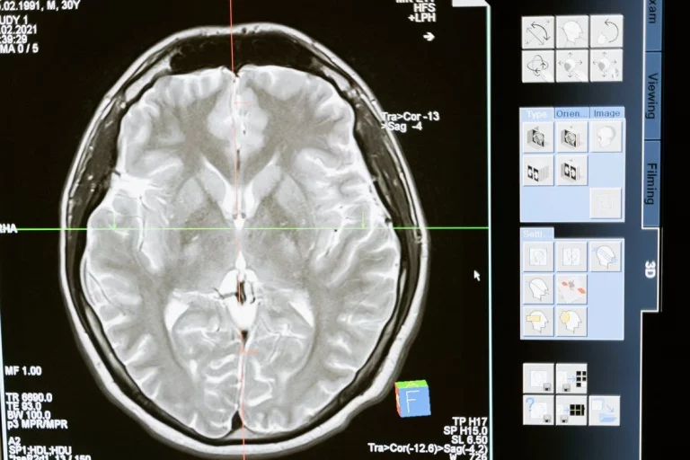 Keto for Brain Health: Does Your Brain Need Carbs?